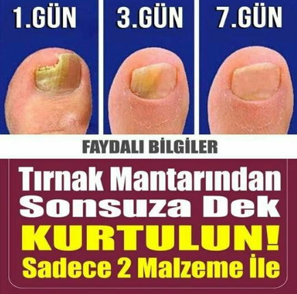 Tırnak Mantarını Yok Eden 2 Doğal Reçete